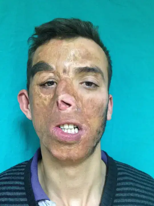 Manavgatlı Uğur Acar: 'Yüzünü Aldığım Kişinin Yaşındayım' 1